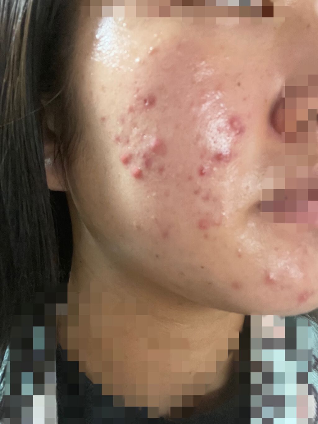 りーちゃん on LIPS 「高校入る前までは気になる程ニキビはありませんでした.ですが高校..」(3枚目)