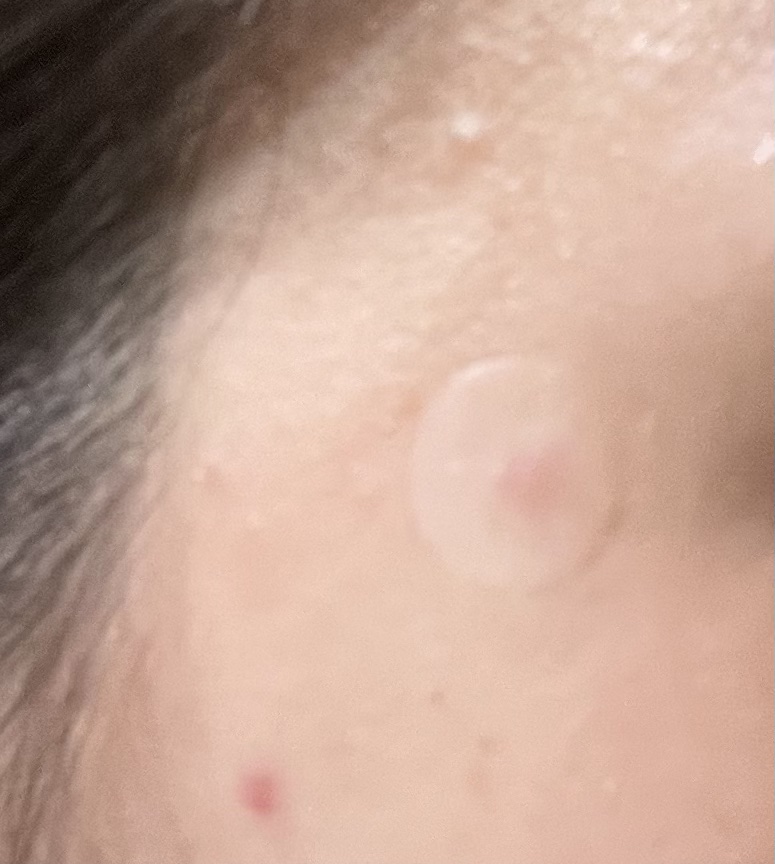 薄型ハイドロコロイドポイントシール/キャンドゥ/その他を使ったクチコミ（2枚目）