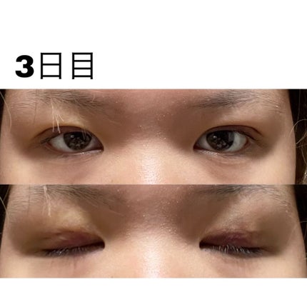 七瀬 on LIPS 「初投稿失礼します!この度ついに念願の二重埋没をしてきました〜!..」(5枚目)