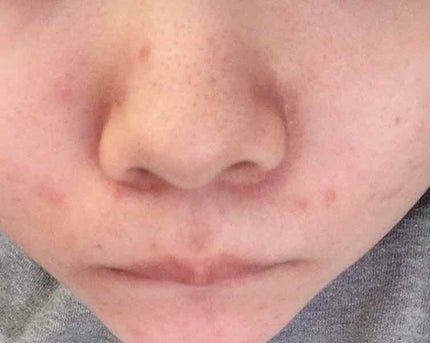 fresh_beauty_8hst on LIPS 「ニキビが悪化しています。中学2年ですどのような薬、またスキンケ..」(1枚目)