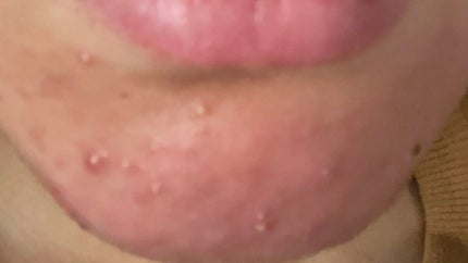 枝豆 on LIPS 「こんな肌と付き合って3年です💧効くと聞いたスキンケア試してきて..」(4枚目)