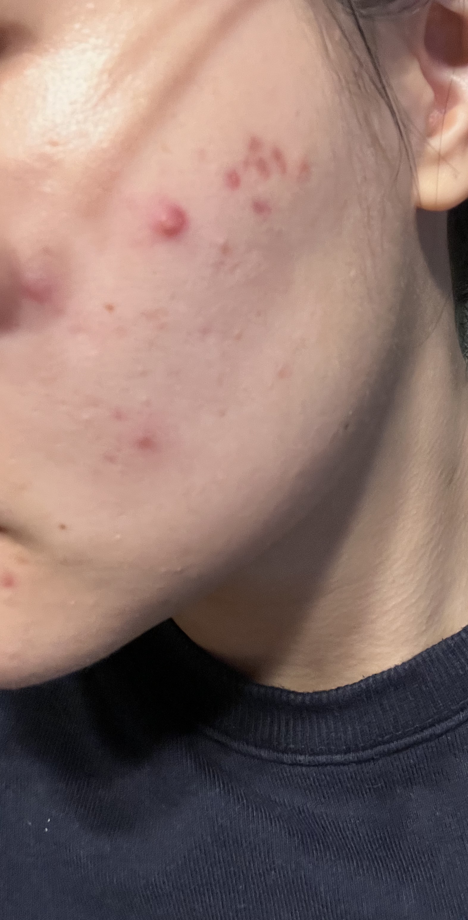 デュアック配合ゲル/デュアック配合ゲル/その他スキンケアを使ったクチコミ（1枚目）