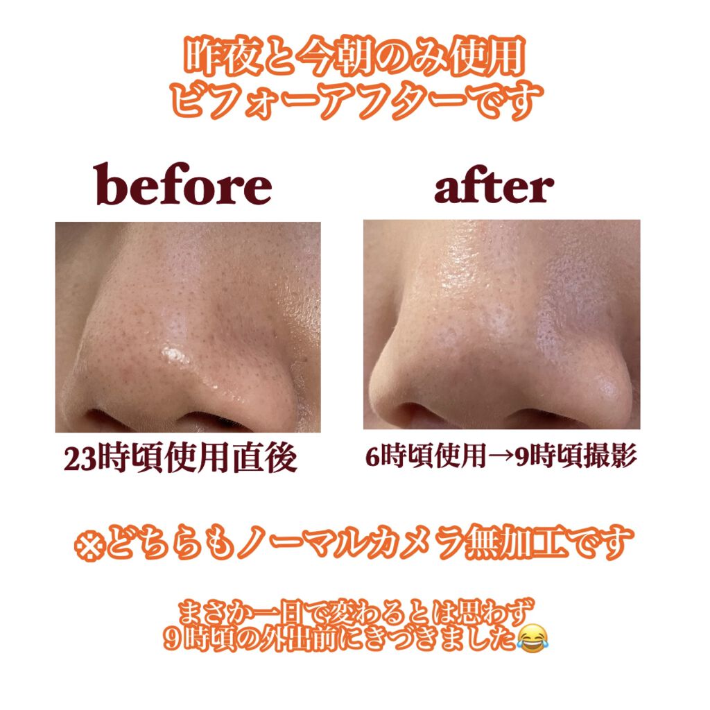 スーパー毛穴ピールセラム/ラボラボ/美容液を使ったクチコミ（2枚目）