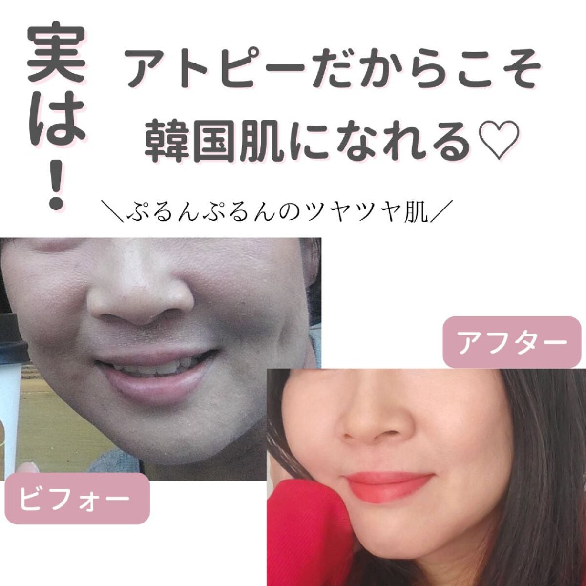 美肌カウンセラー💆肌悩みを解決し見る世界を変える on LIPS 「アトピーを乗りこえた先にある"誰もが手に入れたい陶器肌"それを..」(1枚目)