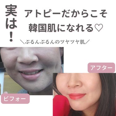 美肌カウンセラー💆綺麗のお助け相談所 on LIPS 「アトピーを乗りこえた先にある"誰もが手に入れたい陶器肌"それを..」（1枚目）