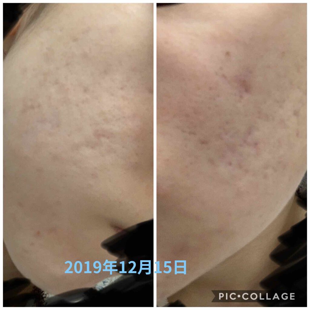 クラリファイング ローション 3/CLINIQUE/拭き取り化粧水を使ったクチコミ（3枚目）