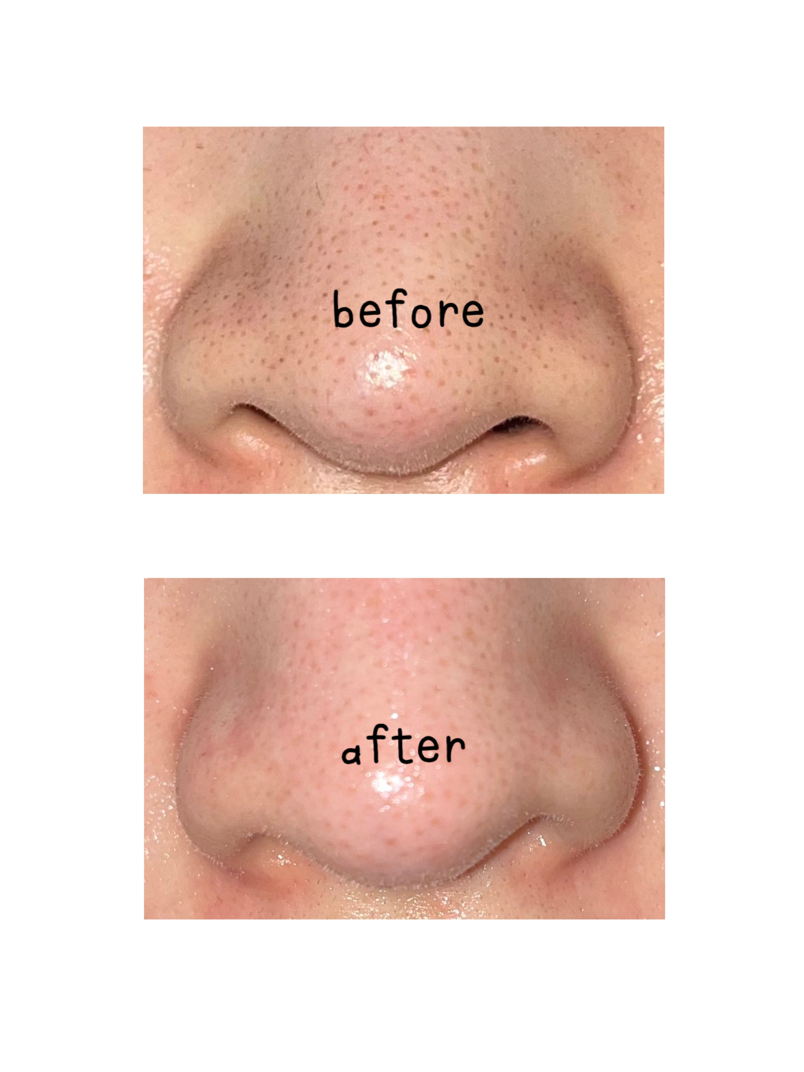 ノーモアブラックヘッド(ノーズピーリング)/One-day's you/スクラブ・ゴマージュを使ったクチコミ（3枚目）