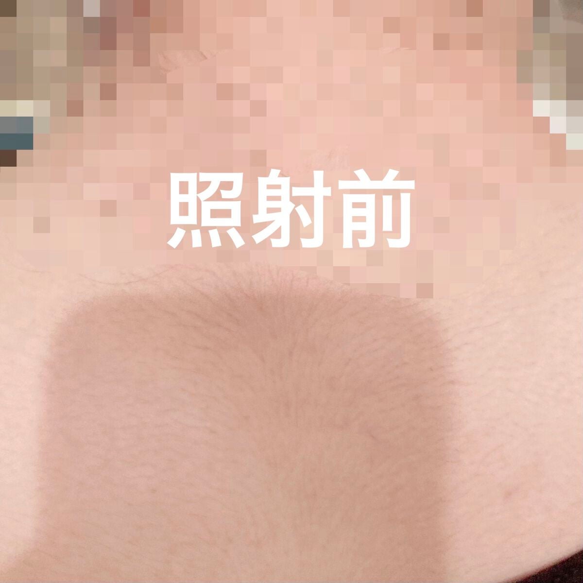 光美容器KE-NON(ケノン)|エムテックの効果に関する口コミ 光美容器KE-NON(ケノン)|エムテックの効果に関する口コミ