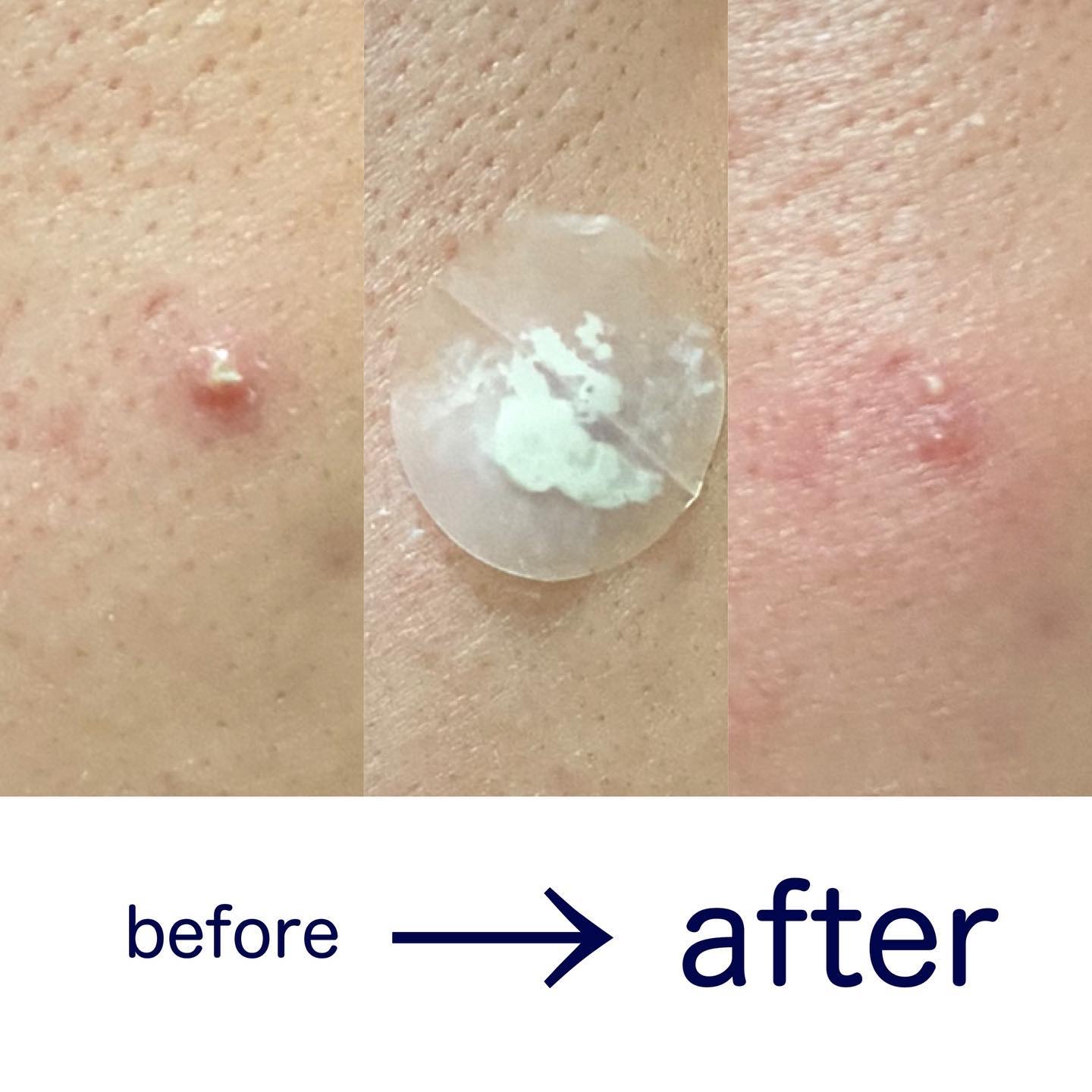 アクネスラボ 相澤メソッド 薬用ミドリクリーム/HIN アクネスラボ/フェイスクリームを使ったクチコミ（2枚目）