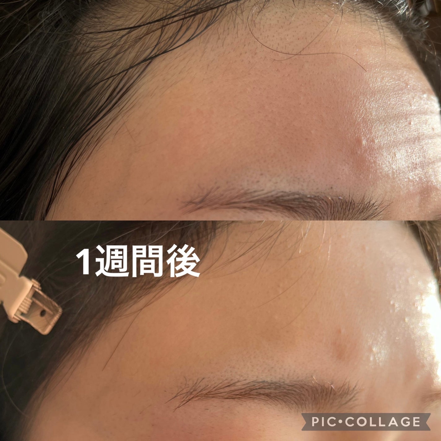 アクネケア セット MB/d プログラム/トライアルキットを使ったクチコミ(3枚目)