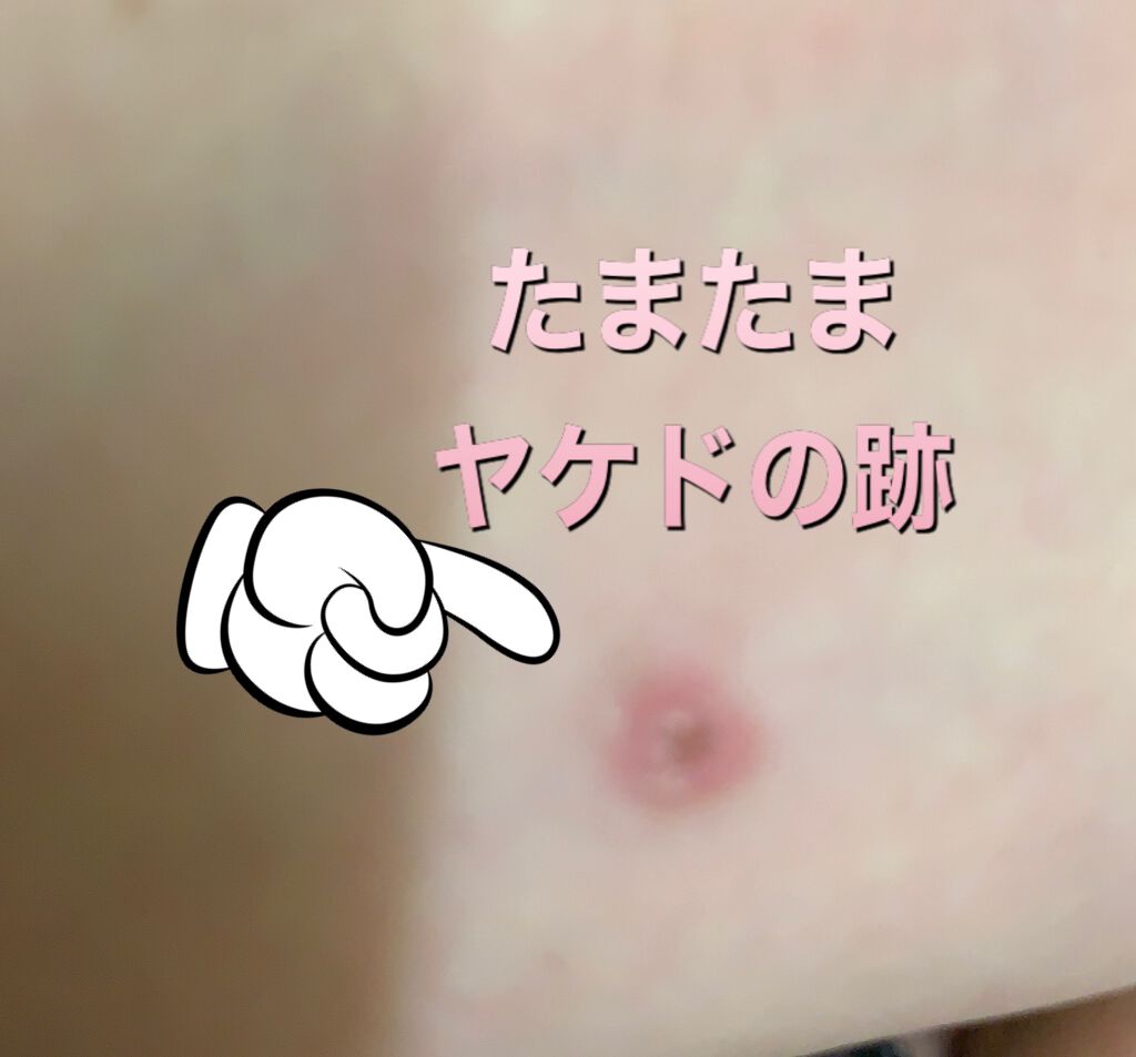 試してみた】アクネカバーアップリキッドフレッシュ／CLINIQUE LIPS