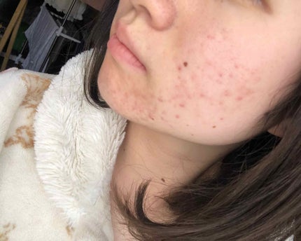 マンスリースキンケアプログラム(旧)/APEX/スキンケアキットを使ったクチコミ(3枚目)