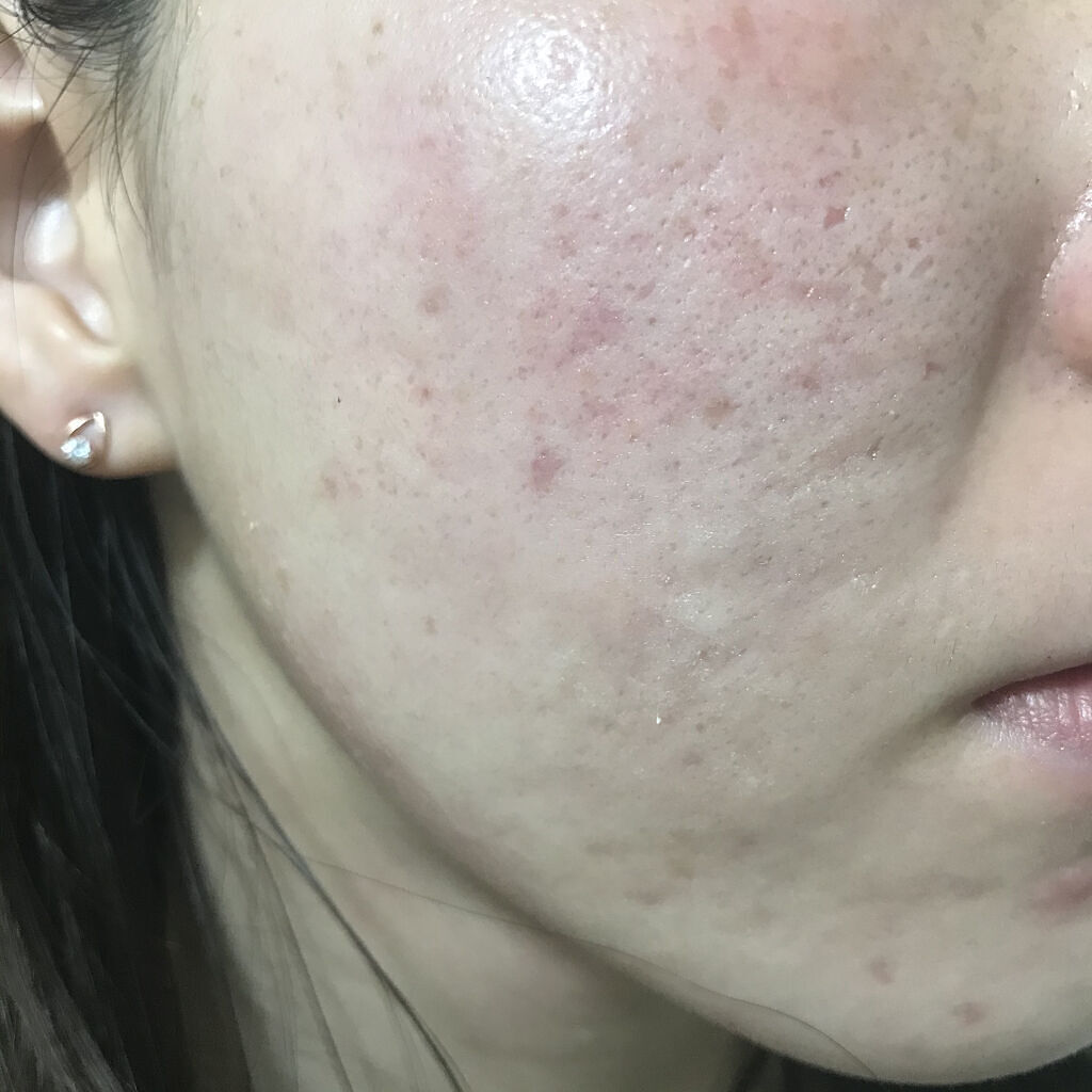 ゼロスポットパッチ/Today’s Cosme/その他スキンケアを使ったクチコミ（1枚目）