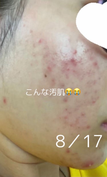 なっちょ🧚‍♂️ on LIPS 「私の肌荒れの治し方❤︎こんな大袈裟に言ってますが私はどんなクリ..」（1枚目）