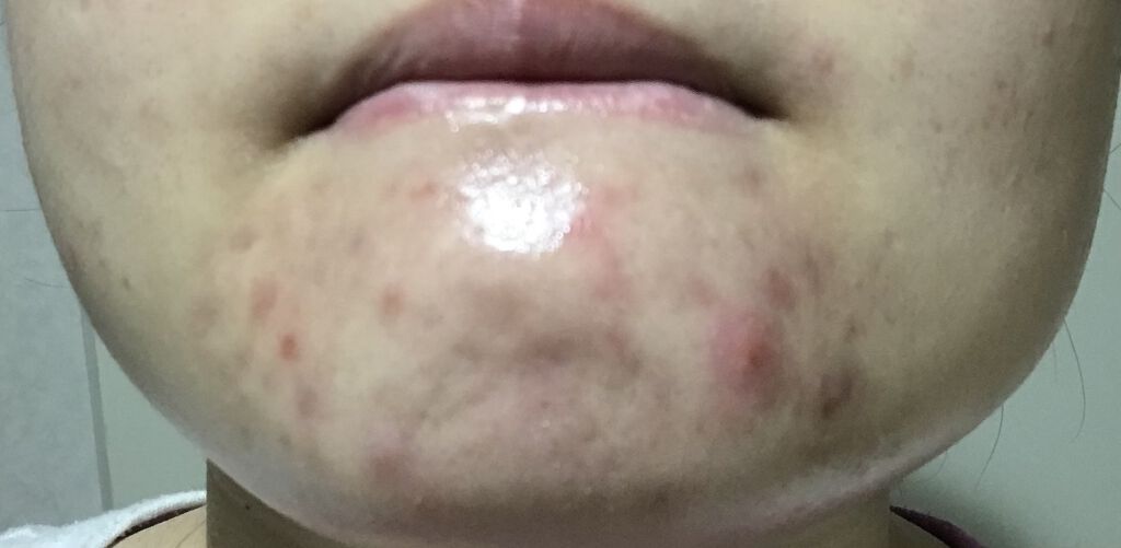 オードムーゲ 薬用ローション（ふきとり化粧水）/オードムーゲ/拭き取り化粧水を使ったクチコミ（1枚目）