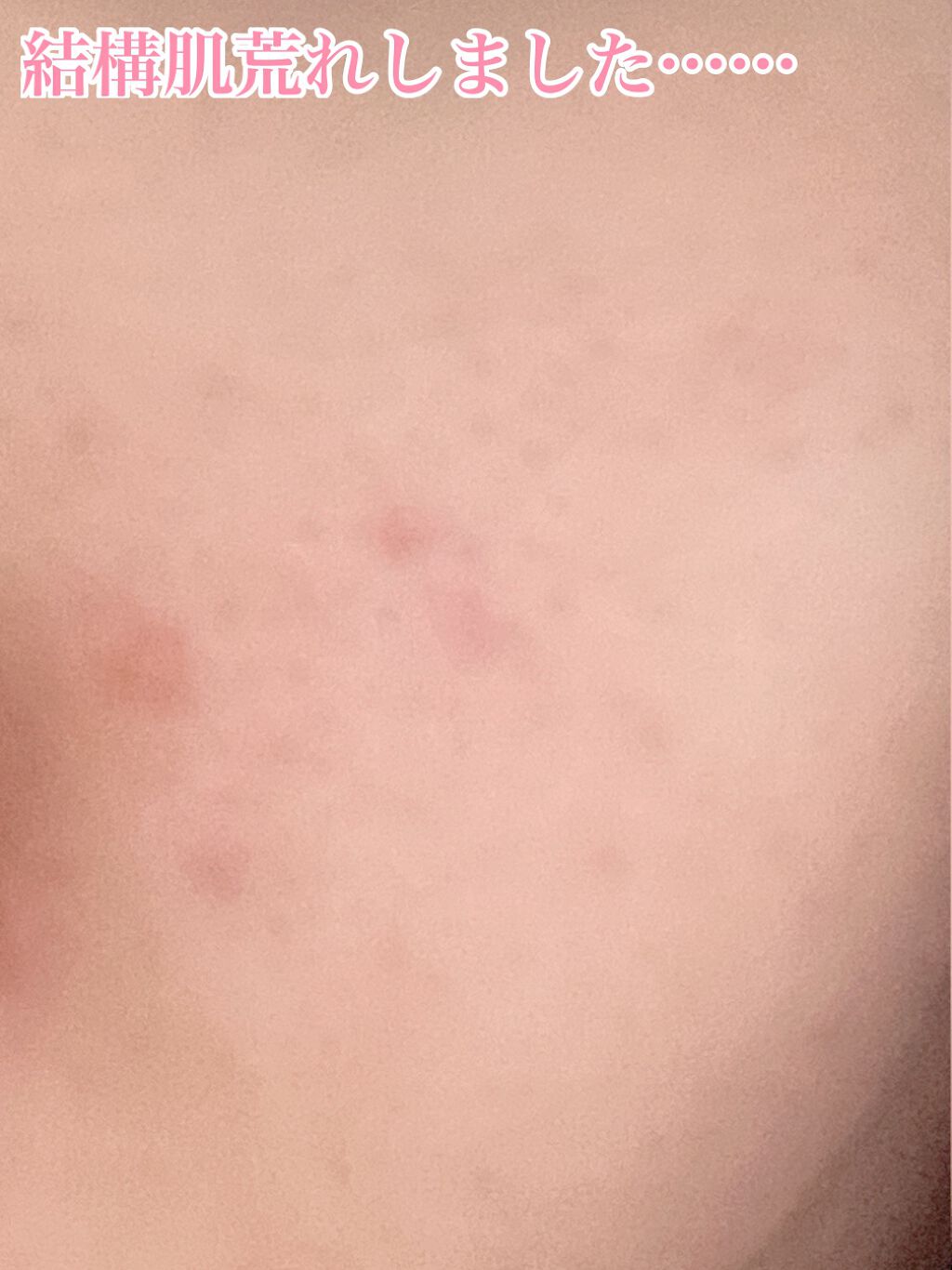 ロゼット洗顔パスタ アクネクリア/ロゼット/洗顔フォームを使ったクチコミ(3枚目)