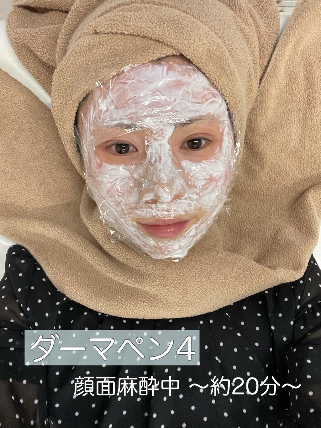 あゆみんっ。 on LIPS 「最近何かと話題な美容医療施術【ダーマペン4】当日終わってまで編..」(1枚目)