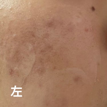 キツネ on LIPS 「今まで右側そんなに肌荒れしてなかったけど、べピオ塗り始めてから..」（1枚目）