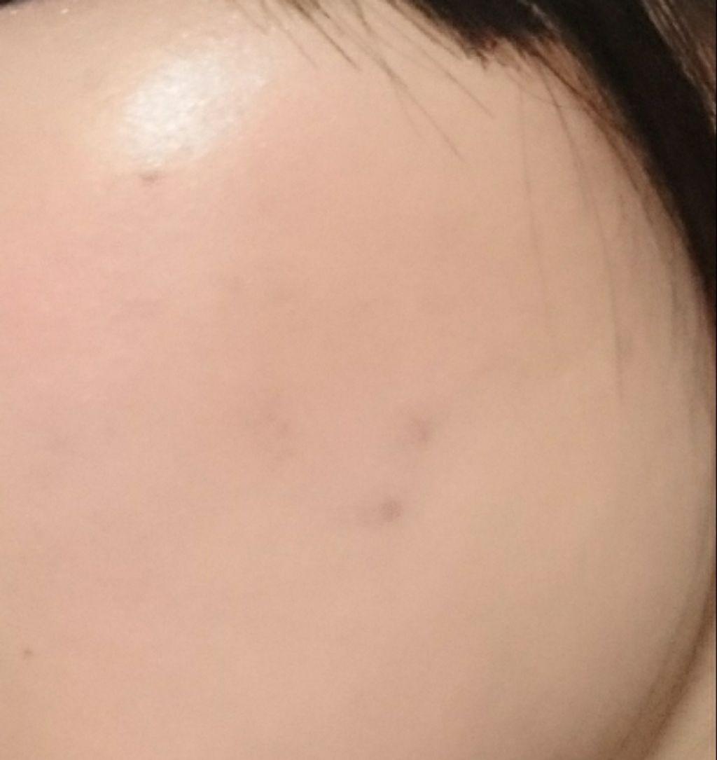 Nexcare/3M nexcare/にきびパッチを使ったクチコミ(2枚目)