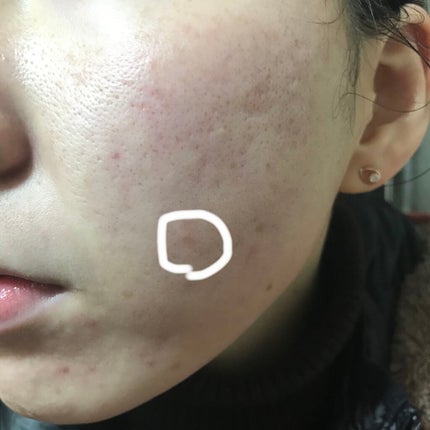 ティーツリーケア ソリューション エッセンシャルマスクEX/MEDIHEAL/シートマスク・パックを使ったクチコミ(3枚目)