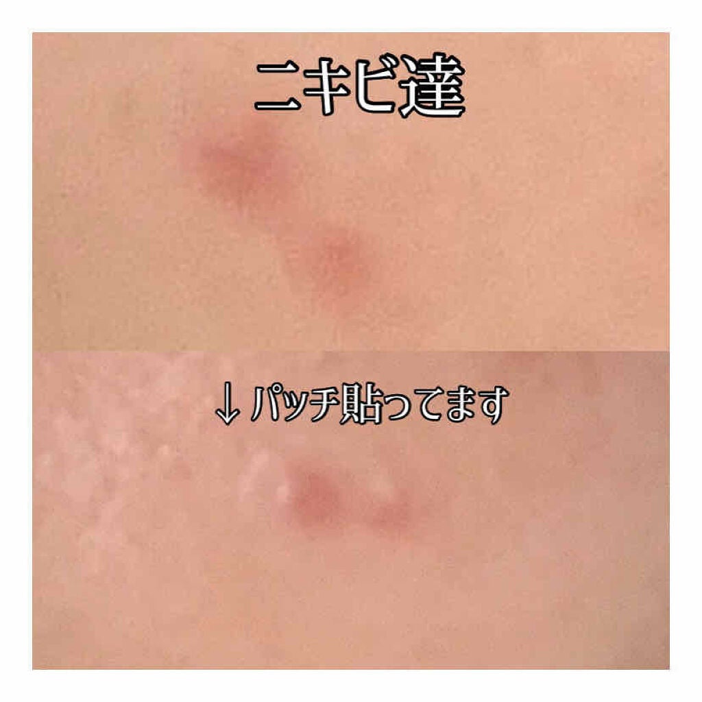 A-zero Shot Trouble Dressing Spot Patch/MEDIHEAL/シートマスク・パックを使ったクチコミ(3枚目)