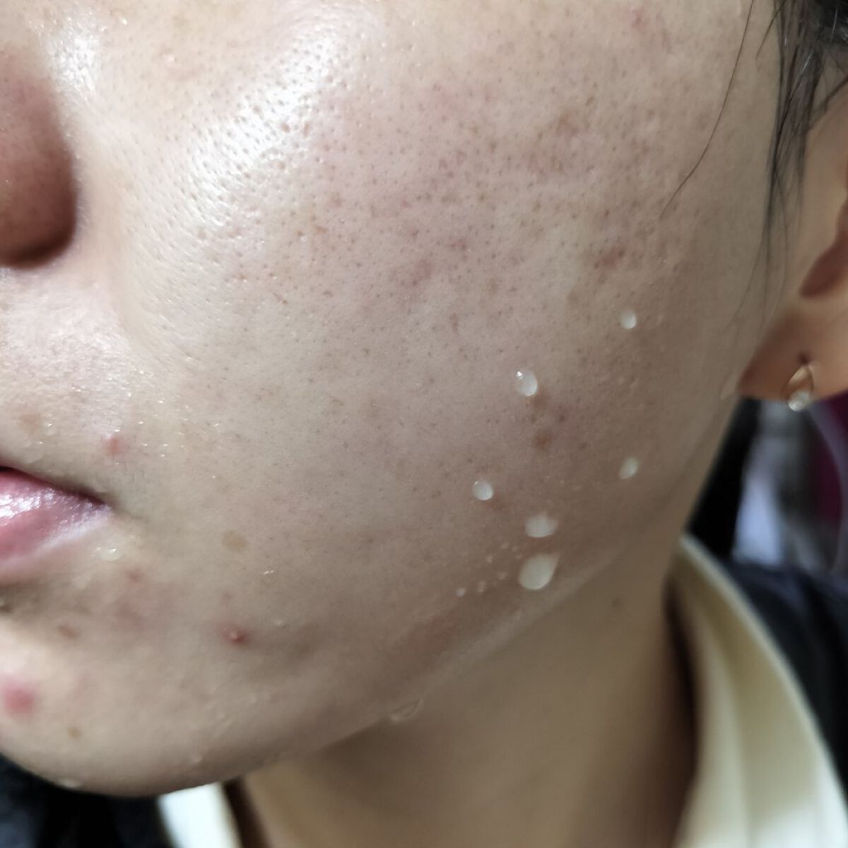 Azelaic Acid Suspension 10%/The Ordinary/美容液を使ったクチコミ（2枚目）