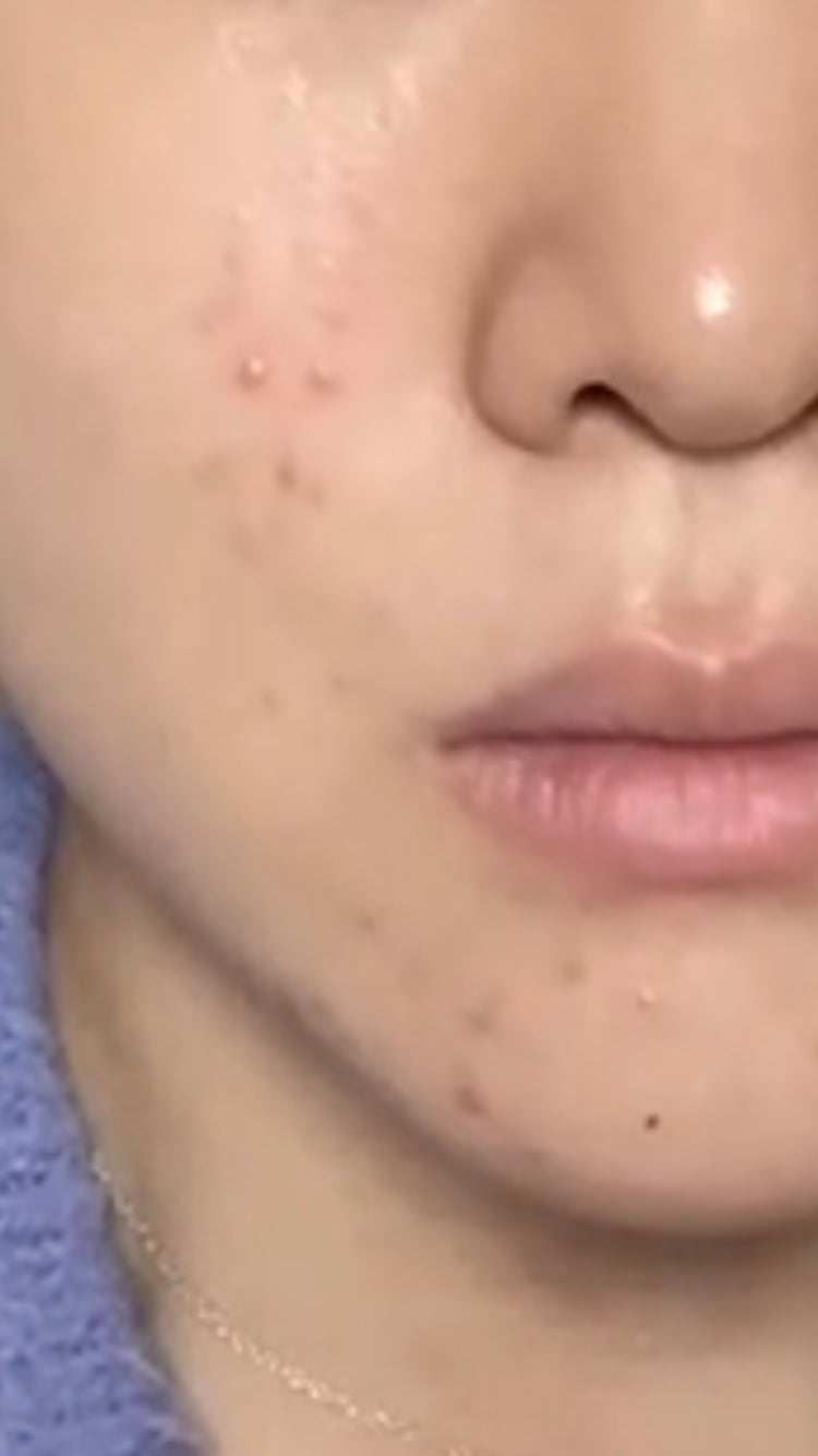 リードルショット100/VT/美容液を使ったクチコミ(2枚目)