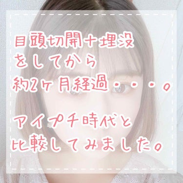 【二重整形から約2ヶ月経過しました】



まず、整形して良かったこと。
・メイク時間がかなーーり短縮された！
・メイクの幅が広がった！
・二重が取れる心配がなくなった！

ほんとに二重によるストレスが