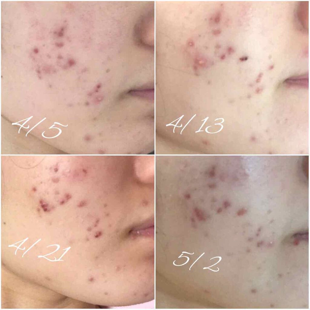 薬用 ニキビ 洗顔石鹸/Non A./洗顔石鹸を使ったクチコミ（2枚目）