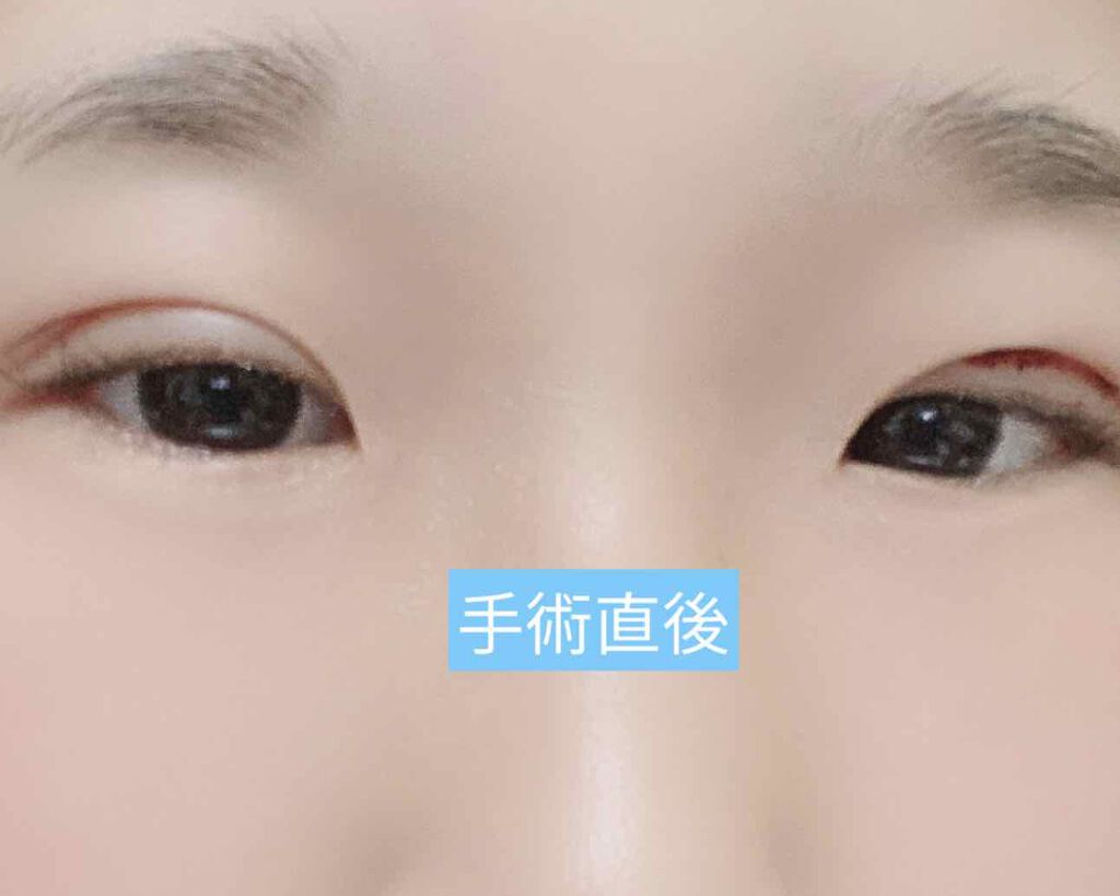 海悠 on LIPS 「二重整形してきました。ずっと一重で悩んでて、お母さんやおばあち..」(3枚目)