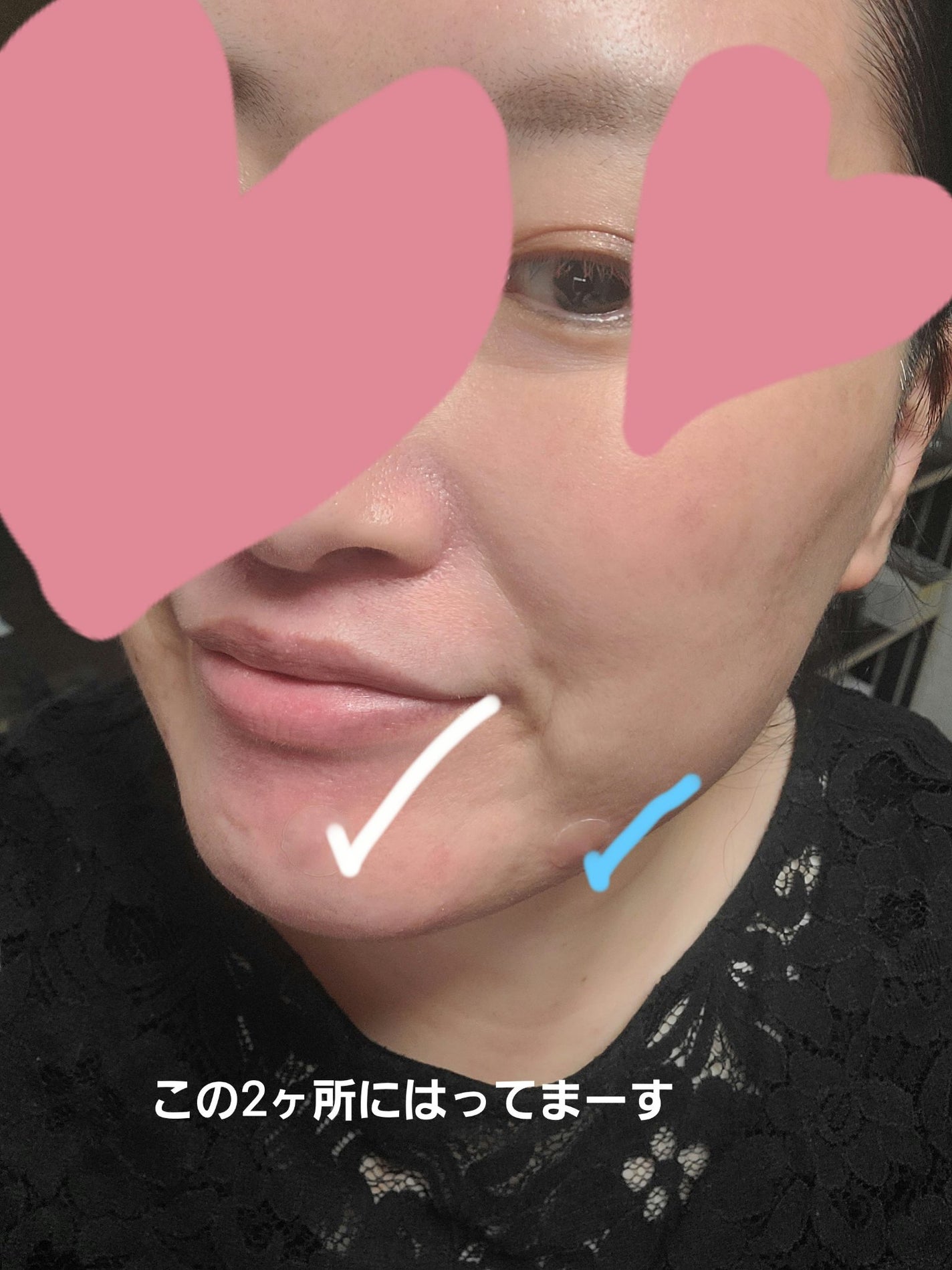 プロCICA クリアスポットパッチ/VT/その他スキンケアを使ったクチコミ(4枚目)