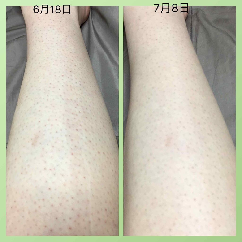 ケアノキュア（医薬品）/小林製薬/その他を使ったクチコミ（3枚目）