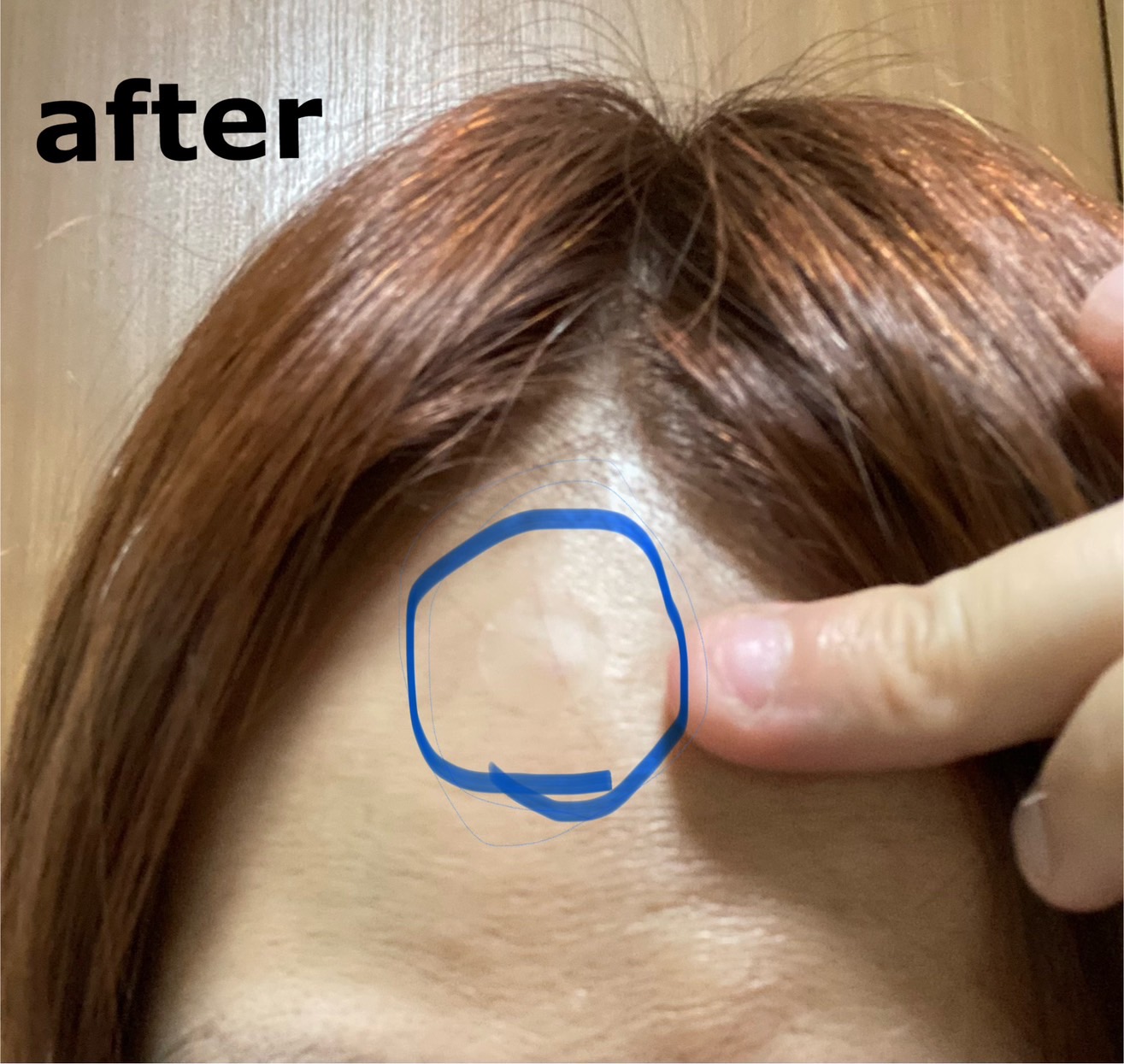 クリアパッチ/Angelab/にきびパッチを使ったクチコミ（2枚目）