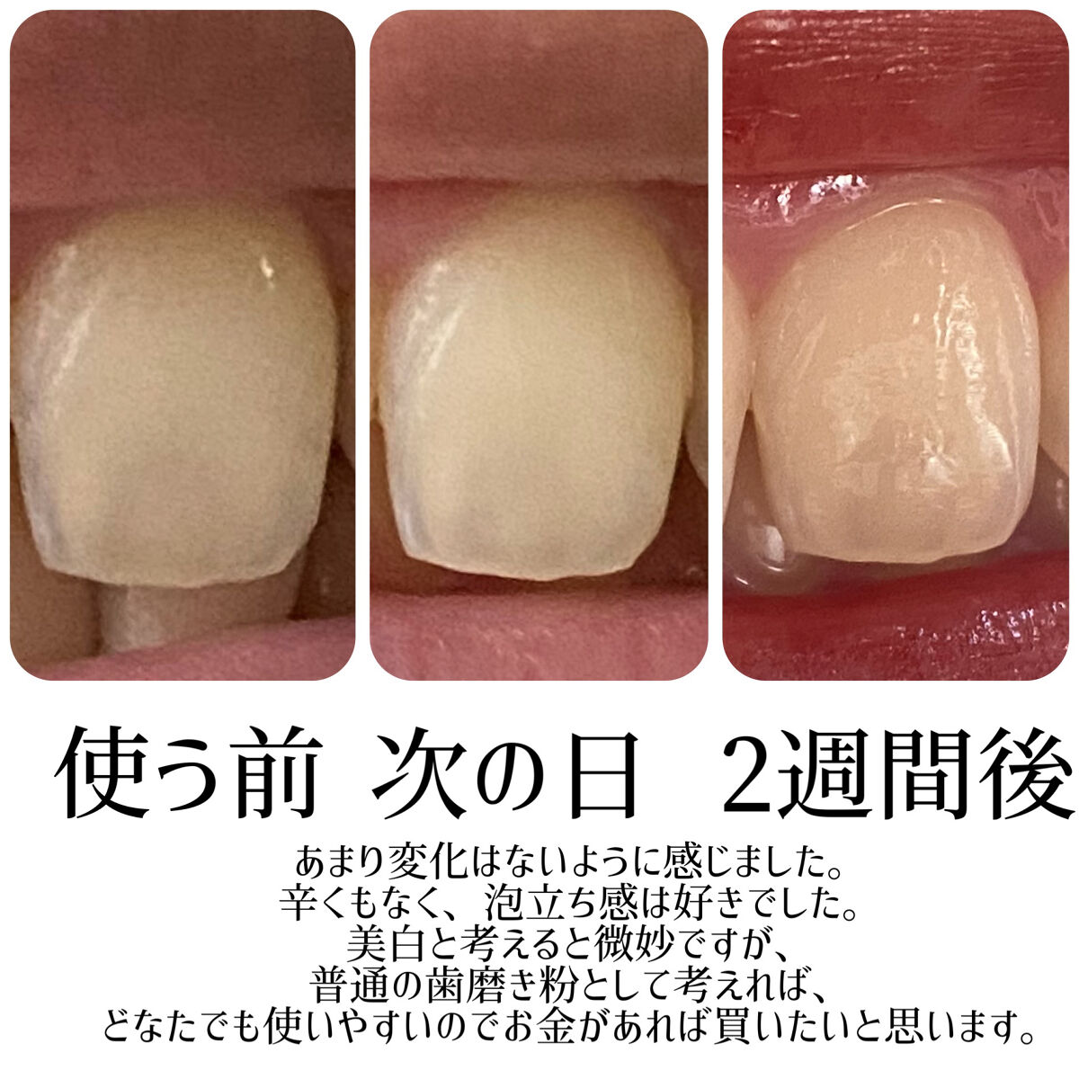 アパガードロイヤル/アパガード/歯磨き粉を使ったクチコミ（3枚目）