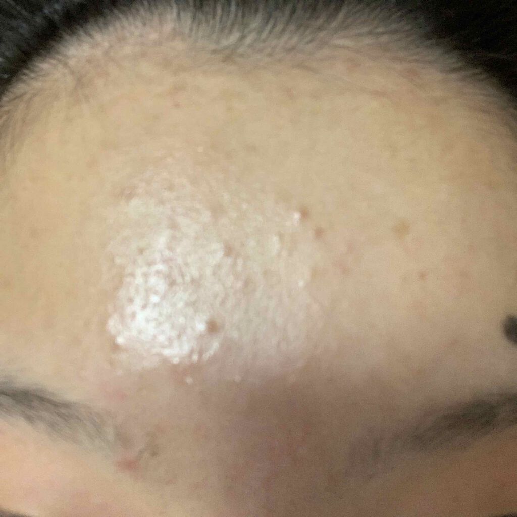 pink_blush_1xo4 on LIPS 「スキンケア方法教えてください!!!全然ニキビが治りません私は今..」(3枚目)