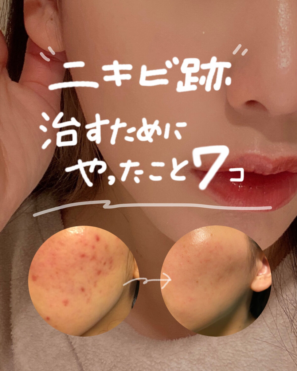 セラミドスキンケア 薬用アクネVCローション/エトヴォス/化粧水を使ったクチコミ（1枚目）