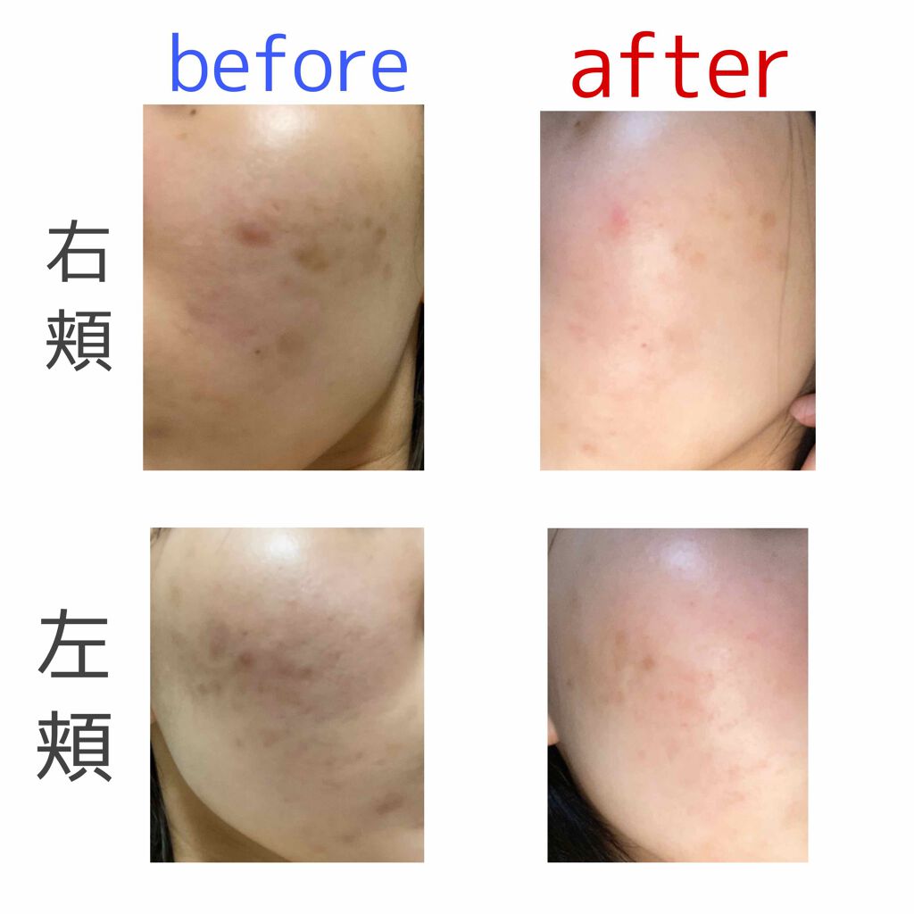 薬用しみ対策 美白化粧水 しっとりタイプ/メラノCC/化粧水を使ったクチコミ(3枚目)