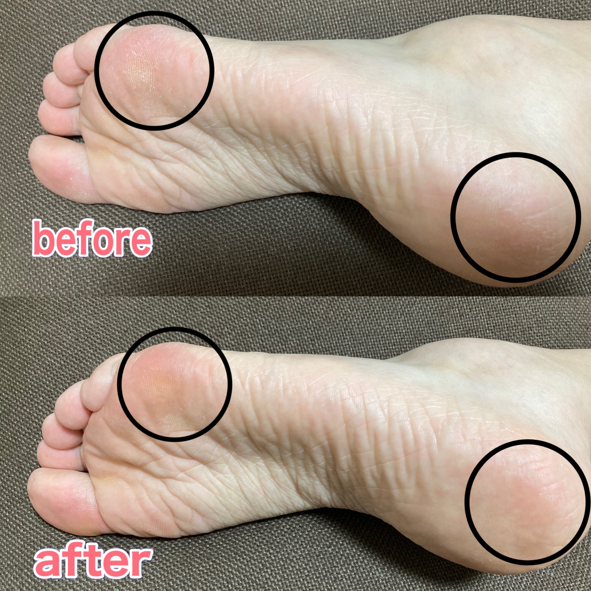 足小路麗子 薬用 フットケアジェル/ナリスアップ/レッグ・フットケアを使ったクチコミ（3枚目）