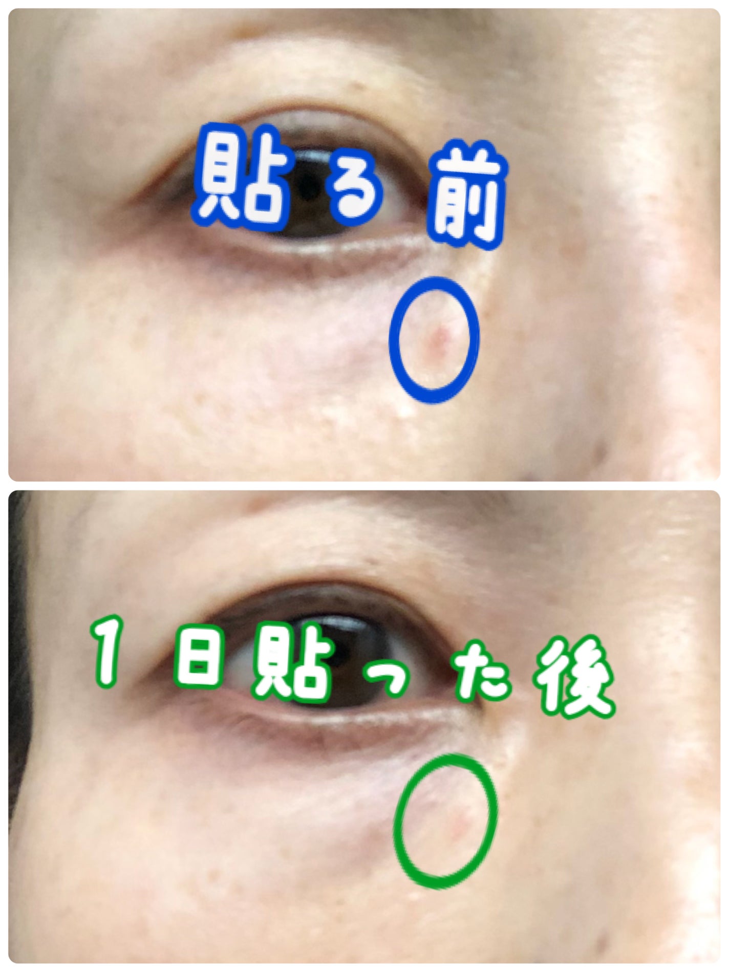 ノスカナイン スポット パッチ/FATION/にきびパッチを使ったクチコミ(3枚目)