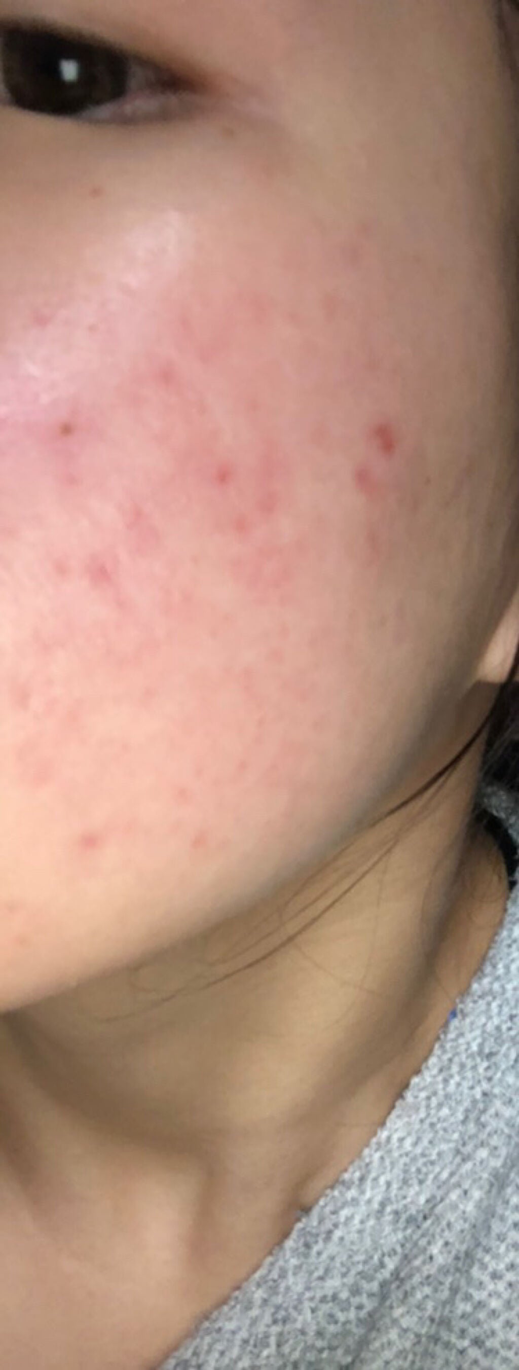 いずみ on LIPS 「どうか助けてください…🥺🙏ニキビとニキビ跡が酷くて、毎日鏡を見..」(2枚目)