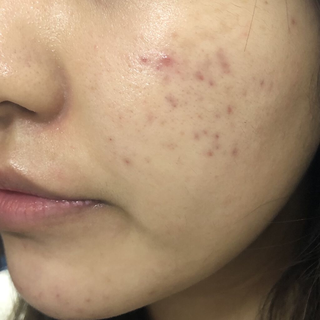 ディフェリンゲル0.1% /マルホ株式会社/その他を使ったクチコミ（1枚目）