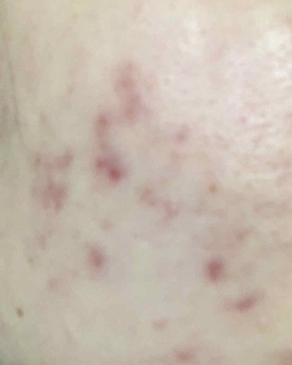 space on LIPS 「生理やったのもあるんか、暴飲暴食。そして寝不足で、ますますひど..」(2枚目)