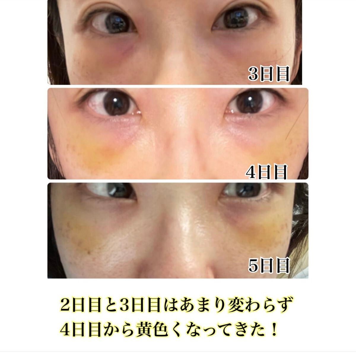 【旧】ディオールスキン フォーエヴァー スキン コレクト コンシーラー/Dior/リキッドコンシーラーを使ったクチコミ(3枚目)