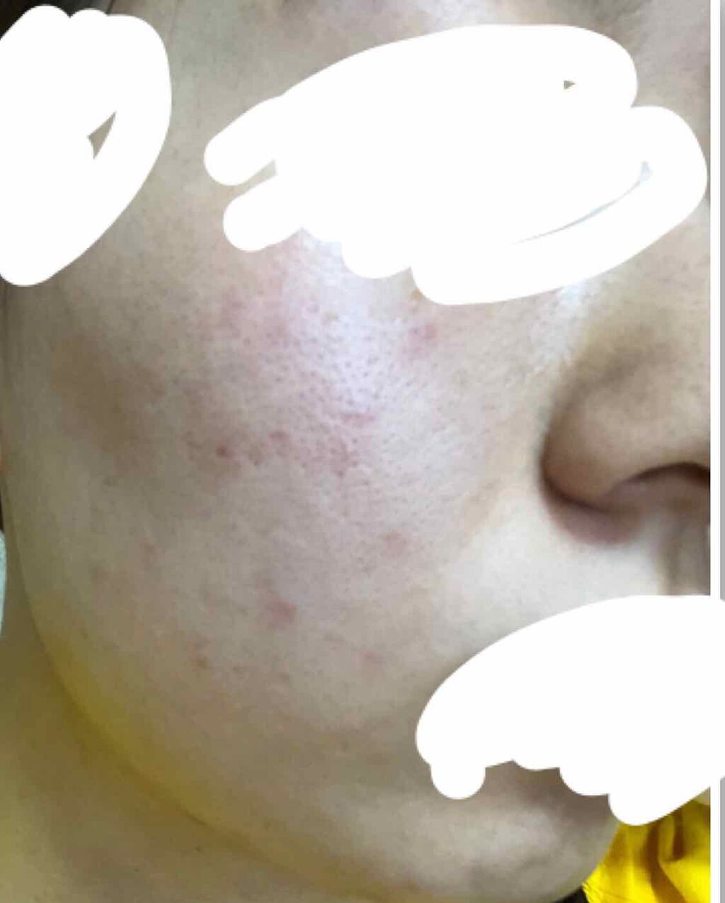 berry_618 on LIPS 「どなたか助けてください🙏🏻《ニキビ・毛穴・黒ずみについて》小学..」(3枚目)