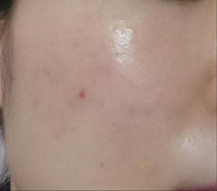 Nexcare/3M nexcare/にきびパッチを使ったクチコミ(2枚目)