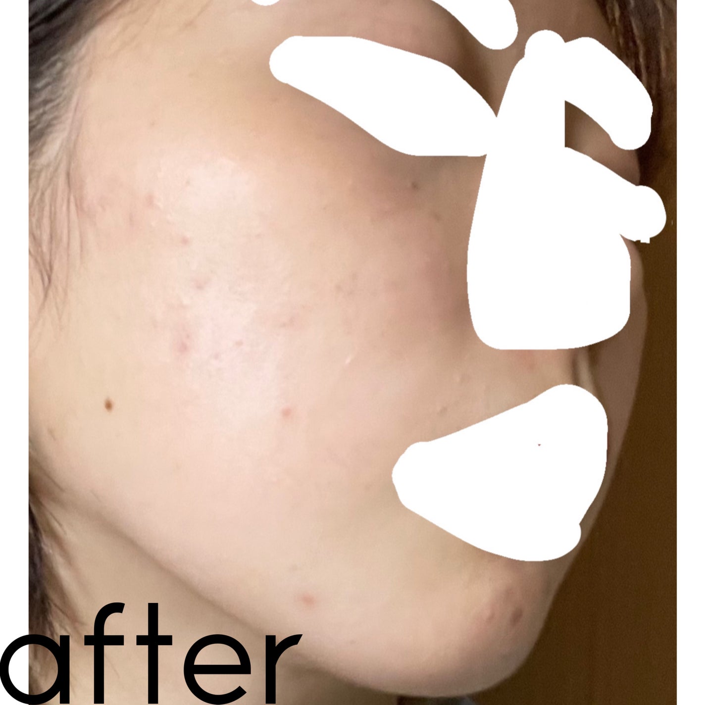 ひな on LIPS 「自己流でいくつか試して見たけどやっぱり皮膚科に行くのがいちばん..」(5枚目)