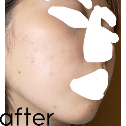 ひな on LIPS 「自己流でいくつか試して見たけどやっぱり皮膚科に行くのがいちばん..」(5枚目)