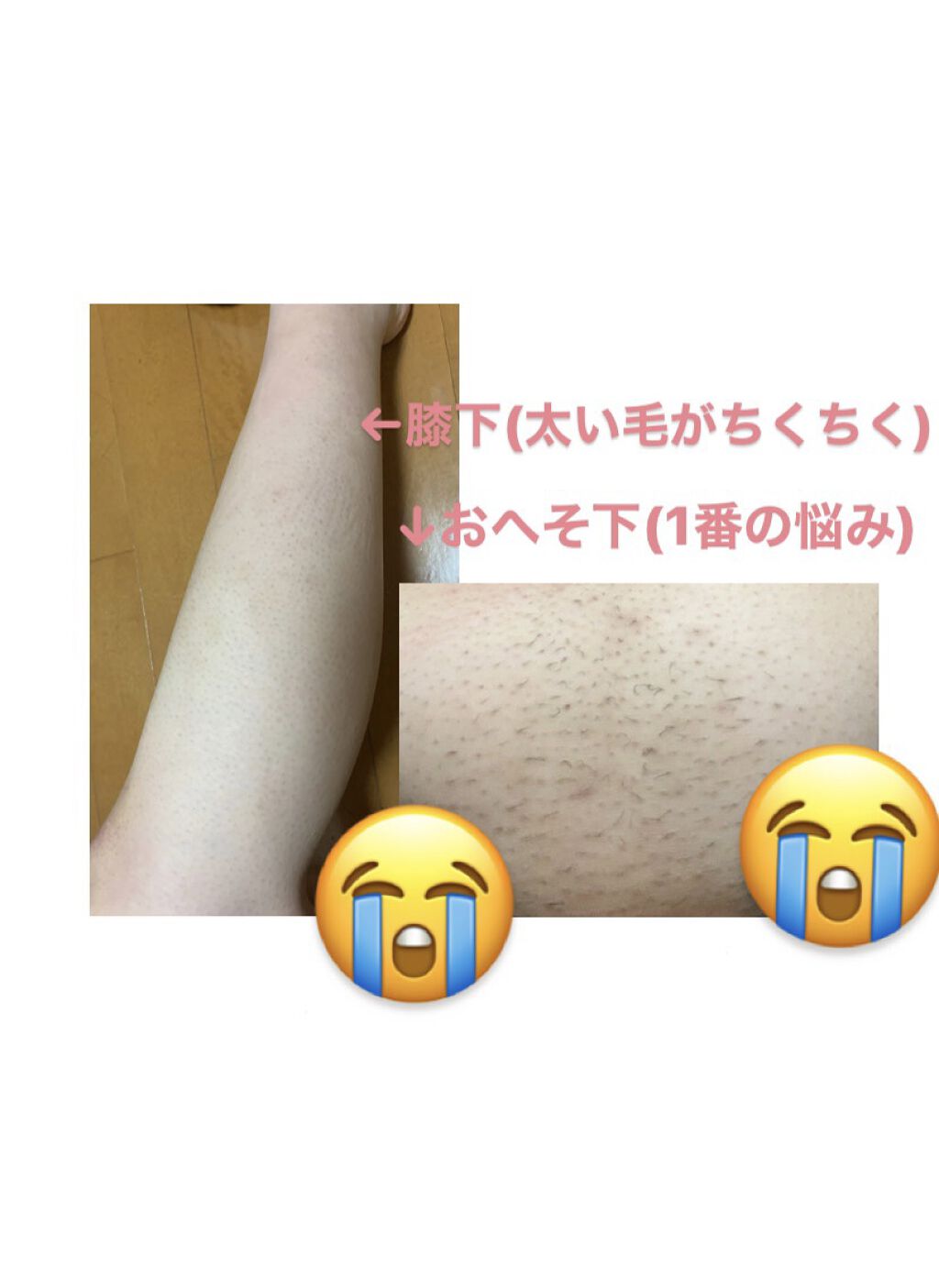 アイスレディ/icelady/家庭用脱毛器を使ったクチコミ（2枚目）