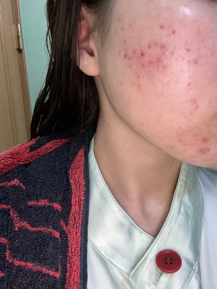 オバジC20セラム/オバジ/美容液を使ったクチコミ(2枚目)