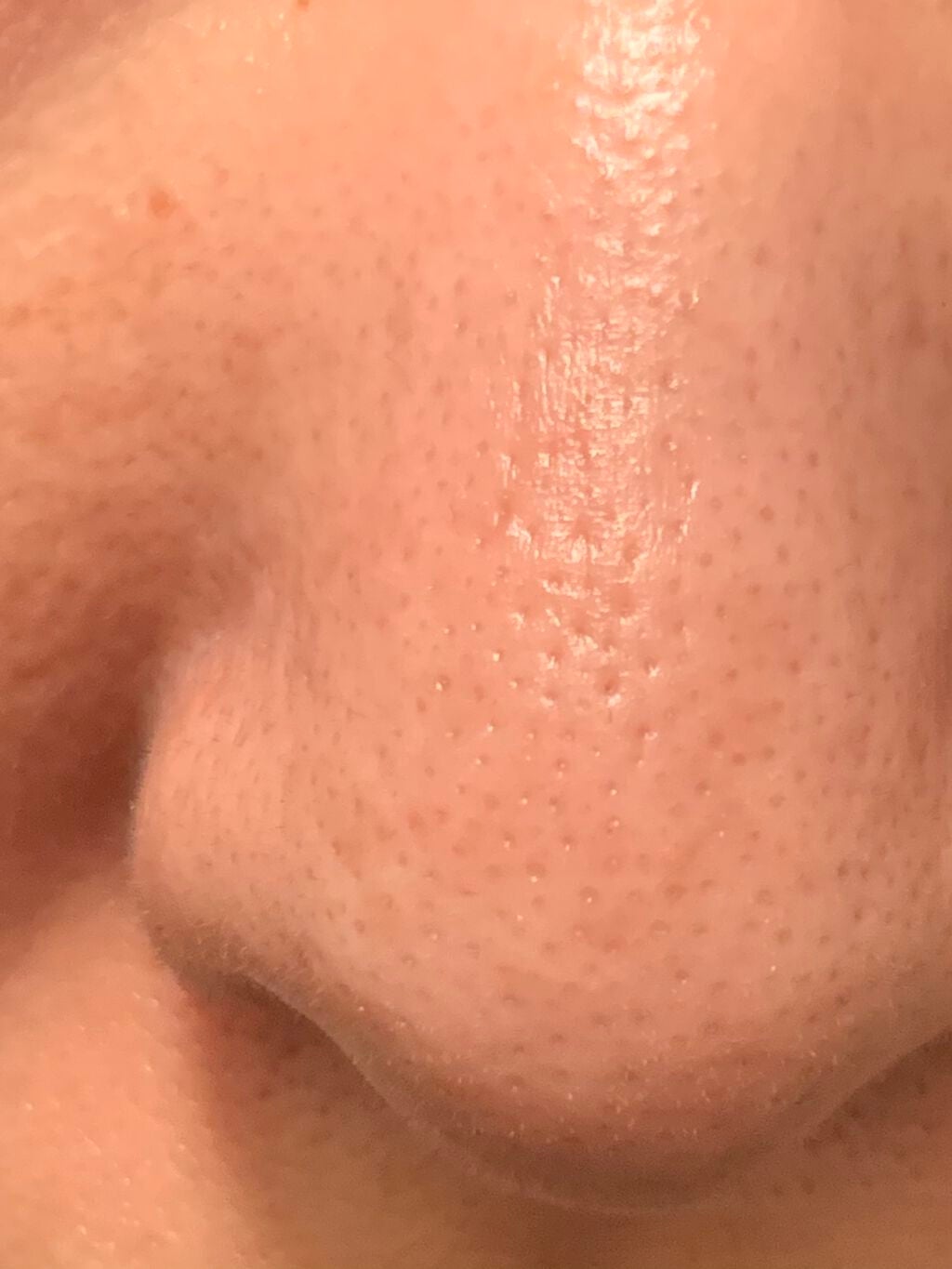 supreme_beauty_y02n on LIPS 「お見苦しい写真すみません。このように鼻の毛穴が開き、たるんでい..」(1枚目)